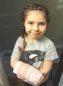 Cast broken arm